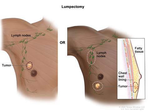 Lymph Nodes In Armpit Men Breast Cancer And The Lymphatic System