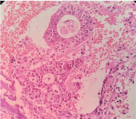 An unexpected finding of bone marrow metastasis from adenocarcinoma of ...