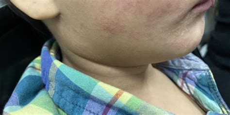 Breaking down the South Carolina measles outbreak: Who has been ...