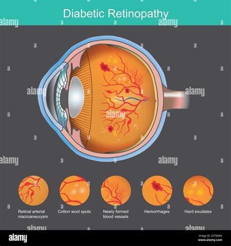 Signs Of Background Diabetic Retinopathy at Lily Bloom blog
