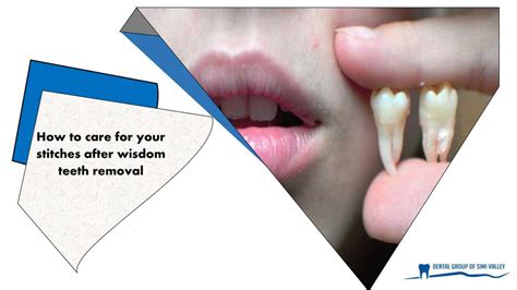 How Do Wisdom Teeth Stitches Dissolve at Terri Whobrey blog