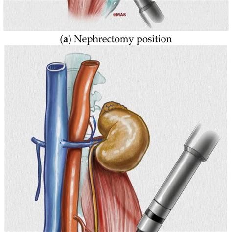 Image result for Retroperitoneal Approach Nephrectomy