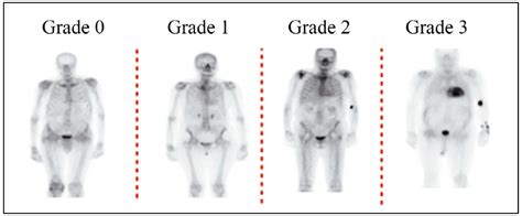 Best Practices in Nuclear Imaging for the Diagnosis of Transthyretin Amyloid Cardiomyopathy ...