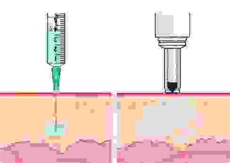 Comfort-inTM Needle-Free Injections