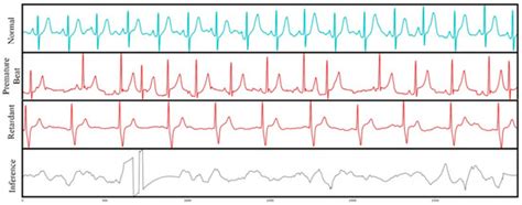Real-Time Remote Health Monitoring System Driven by 5G MEC-IoT