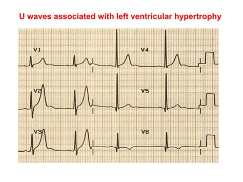 U WAVE IN ECG AND ITS ABNORMALITIES IN ECG | PPTX