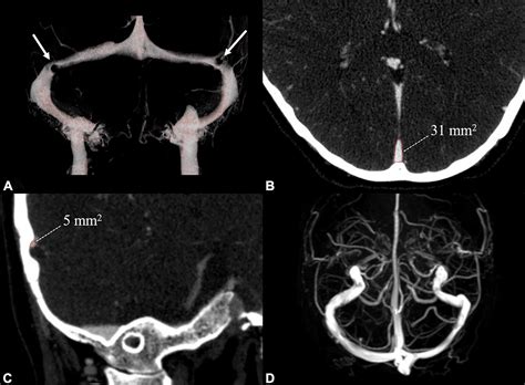 Frontiers | Transverse Sinus Stenosis in Venous Pulsatile Tinnitus ...