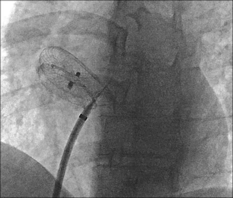 PFO Defect 的图像结果