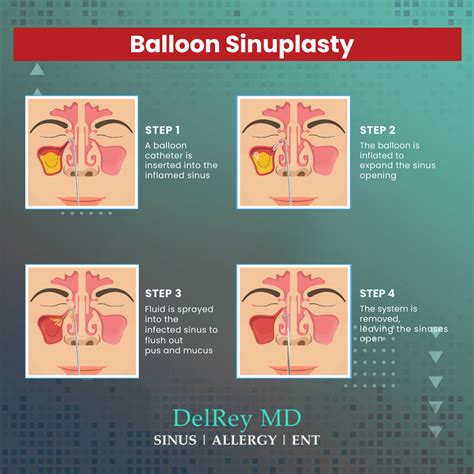 Stop Sinusitis Marina Del Rey - Sinusitis Treatment Los Angeles