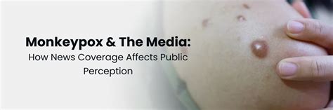 Impact of Media Coverage on Public Perception of Monkey Pox