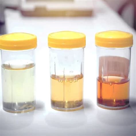 Urine Colour: হলুদ, সবুজ, বাদামী না লাল...? আপনার প্রস্রাবের 'এই' ৬ রং ...