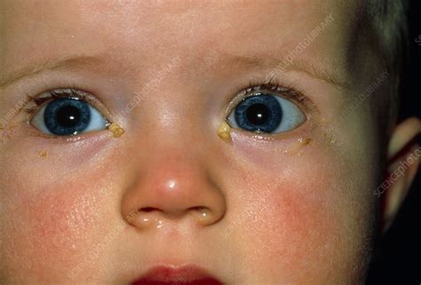 Close-up of baby's eyes with acute conjunctivitis - Stock Image - M155 ...