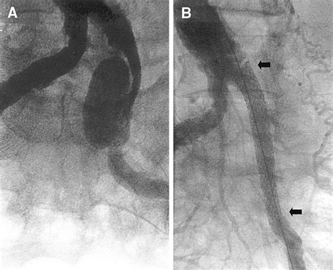 Treatment of Iliac Artery Aneurysms by Percutaneous Implantation of Stent Grafts | Circulation