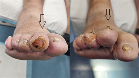 Diabetic toe ulcers: A comprehensive overview | Foot & Podiatry Surgery