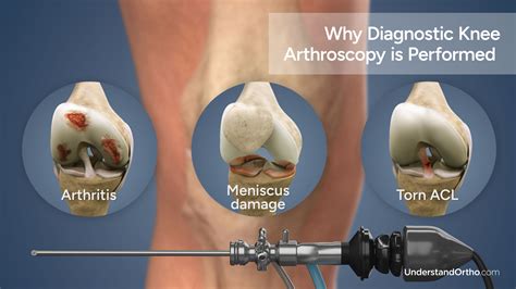 Diagnostic Knee Arthroscopy – UnderstandOrtho™