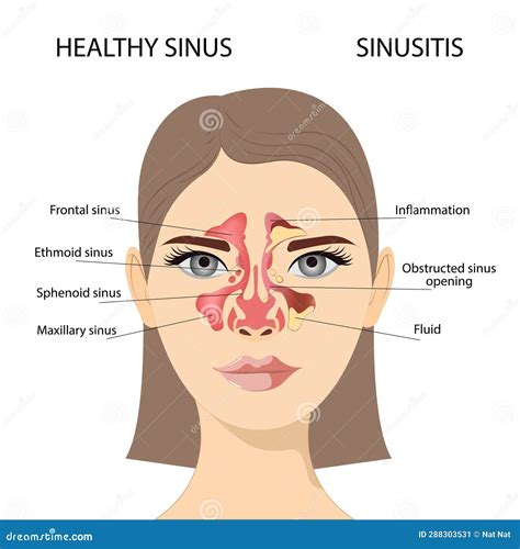 Sinusitis, Female Face With Inflammation Of The Mucous Membrane Of The Paranasal And Frontal ... - illustration of sinuses