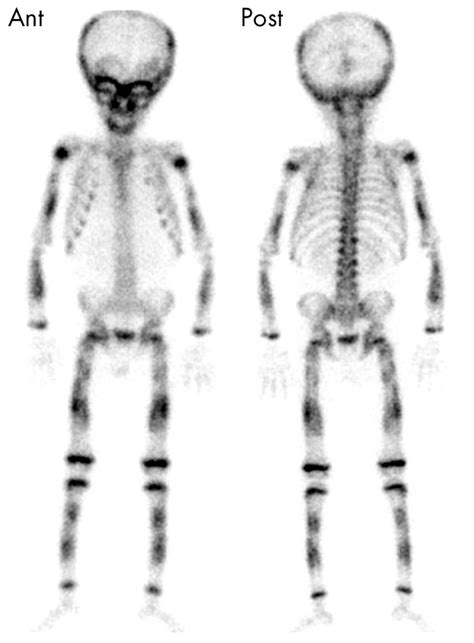Image result for Normal Bone Scan