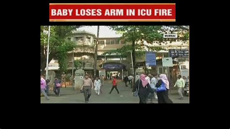 Mumbai: 2-month-old baby's arm amputated after suffering burn injuries