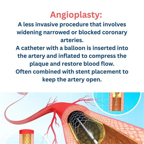PPT - Bypass Surgery vs. Angioplasty PowerPoint Presentation, free download - ID:12311821