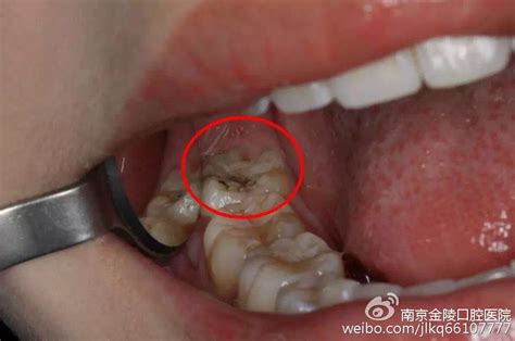 在南京口腔医院拔一颗智齿要多少钱?很疼么_
