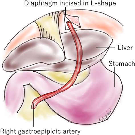 Minimally invasive coronary artery bypass grafting using the skeletonized right gastroepiploic ...
