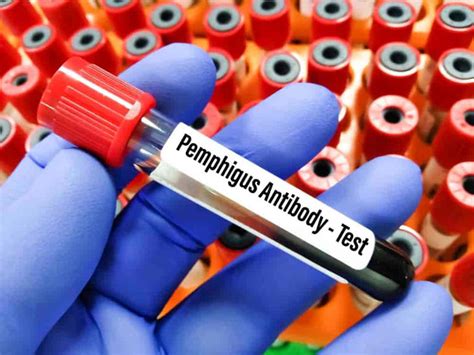 Pemphigus: Types, Symptoms, Causes, Diagnosis and Treatment