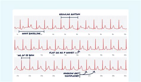Junctional Rhythm Rate