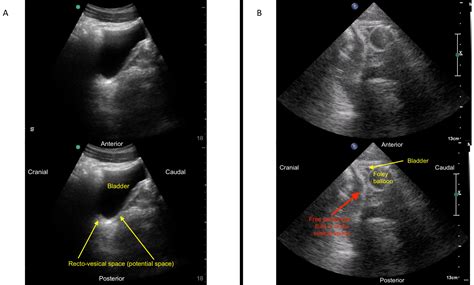 Focused Assessment with Sonography for Trauma (FAST) Exam: Image ...