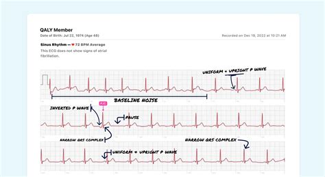 Premature Junctional Contraction (PJC) Vs. Premature Atrial Contraction ...
