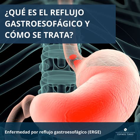 ¿Qué es el reflujo gastroesofágico y cómo se trata? - Instituto de Aparato Digestivo Teknon
