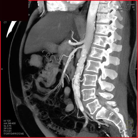 Superior Mesenteric Artery (SMA) Stenosis - Vascular Radiology Case Studies - CTisus CT Scanning