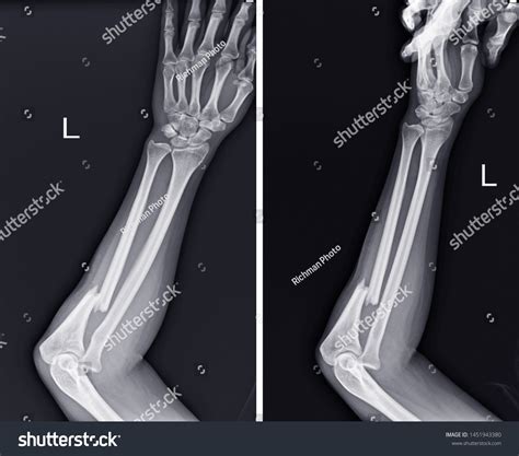 Forearm X Ray