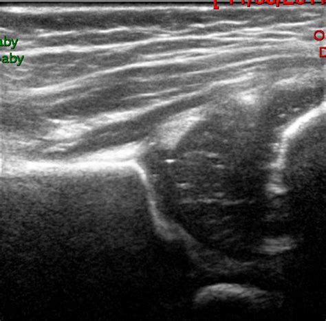 How to use… Hip examination and ultrasound in newborns | ADC Education ...