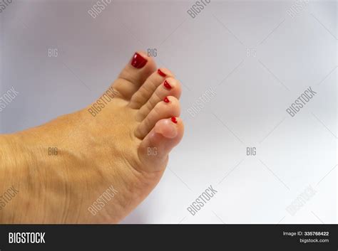 Corn On Pinky Toe