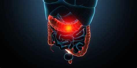 CBD und Morbus Crohn – Aktuelle Forschung und Erfahrungen - Hanf Extrakte