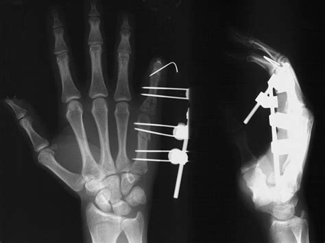 Image result for External Fixation Explained