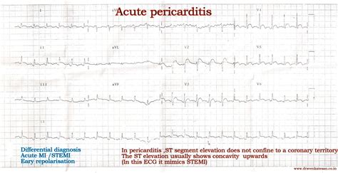 Stemi Vs Pericarditis Ecg