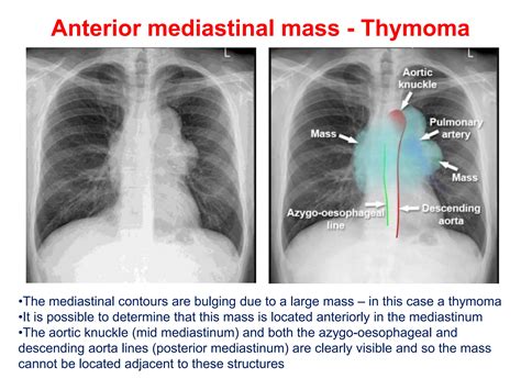 CHEST X-RAY MEDIASTINUM AND HILUMpptx.pptx