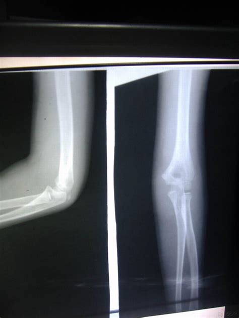 7岁小女孩肘关节后脱位，肱骨内上髁骨骺分离，复位后带图片 - 骨科与显微外科专业讨论版 - 爱爱医医学论坛