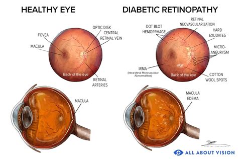 Diabetes-Related Retinopathy: Causes, Treatment, Signs & Symptoms