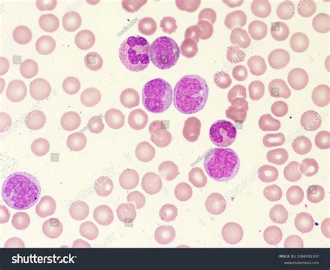 Leukemia Blood Cells Blast Cells Immatured Stock Photo 2268782307 ...
