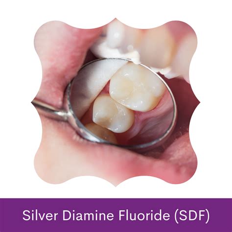 Silver Diamine Fluoride (SDF) | Roving Dental Hygiene