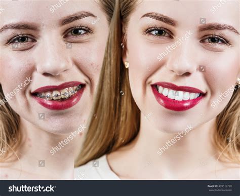 Buck Teeth Before And After Braces