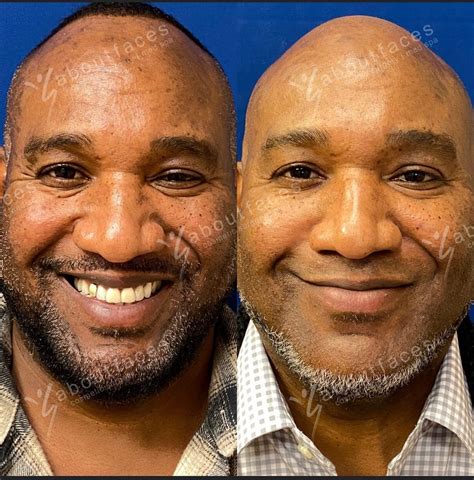 Specials & Events — About Faces Cosmetic Surgery and Med Spa