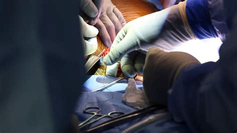 Kidney Transplant Crisis: Why 98% of Patients in Delhi Die Waiting