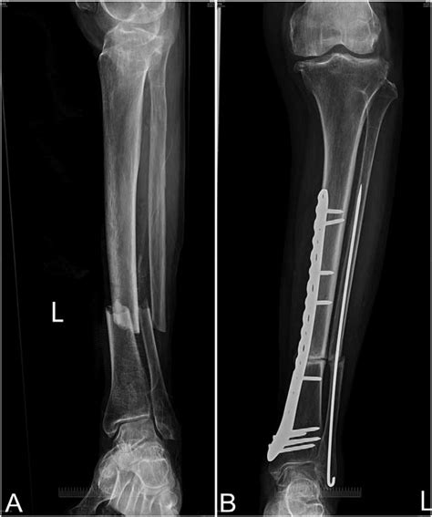 (A) The radiograph of left tibia and fibula shaft open fracture (type... | Download Scientific ...
