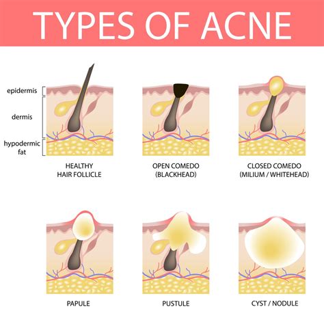 What is acne? Vedas Medical Spa & Wellness Center