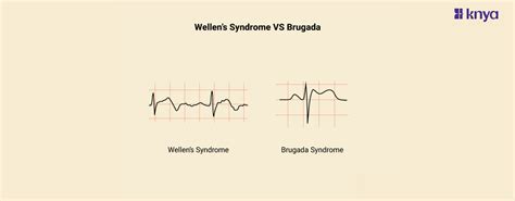Wellens Syndrome vs Brugada Syndrome, Cardiac Diseases – Knya