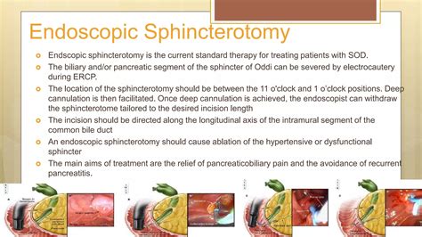 Sods sphincter of Oddi Dysfunction | PPTX