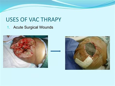 VACUUM ASSISTED WOUND THERAPY | PPTX